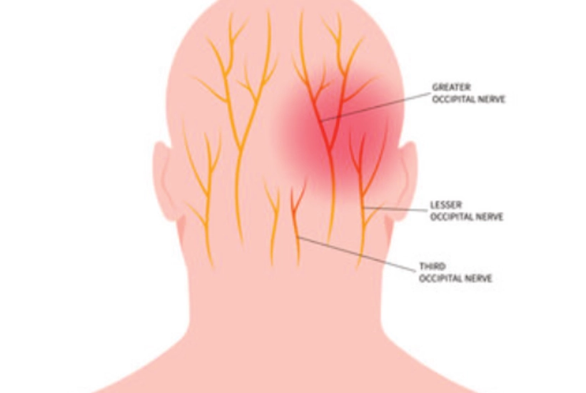 Cervicogenic Headaches