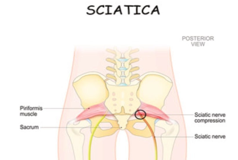 Piriformis Syndrome