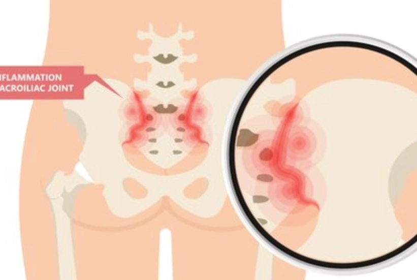 Physiotherapy for SI Joint Dysfunctions Sacroiliac Joint Dysfunctions