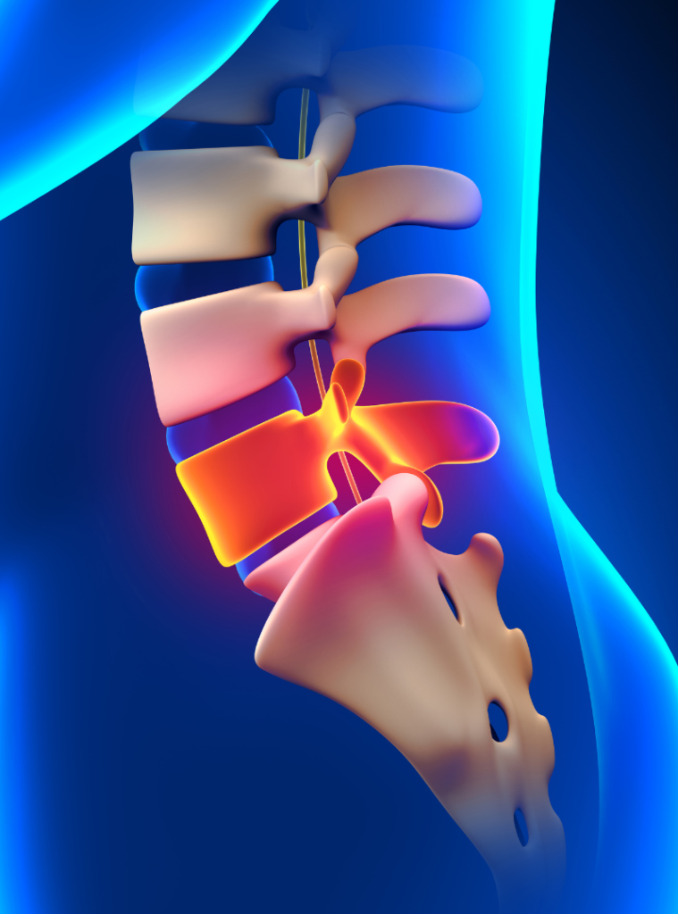 What Exactly Is Sciatica?