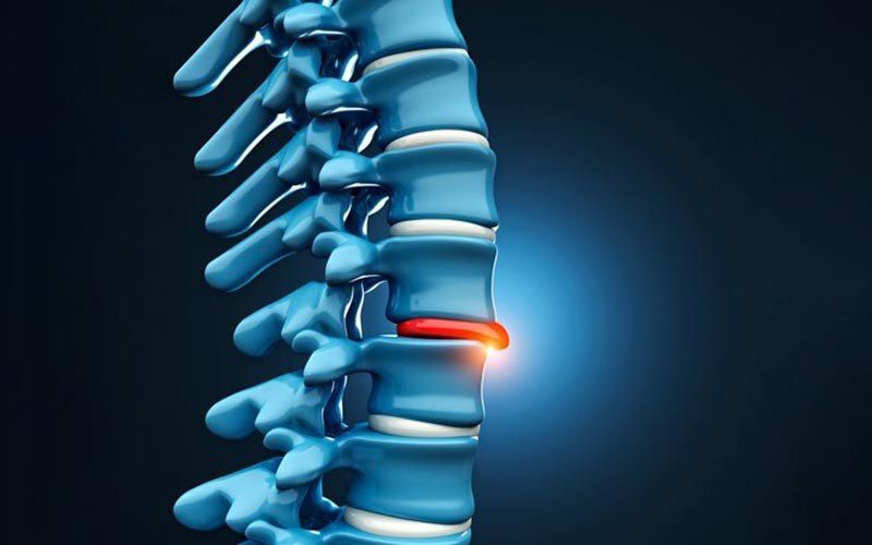 Slip Disc & Sciatica: How Physiotherapy Helps You Avoid Surgery